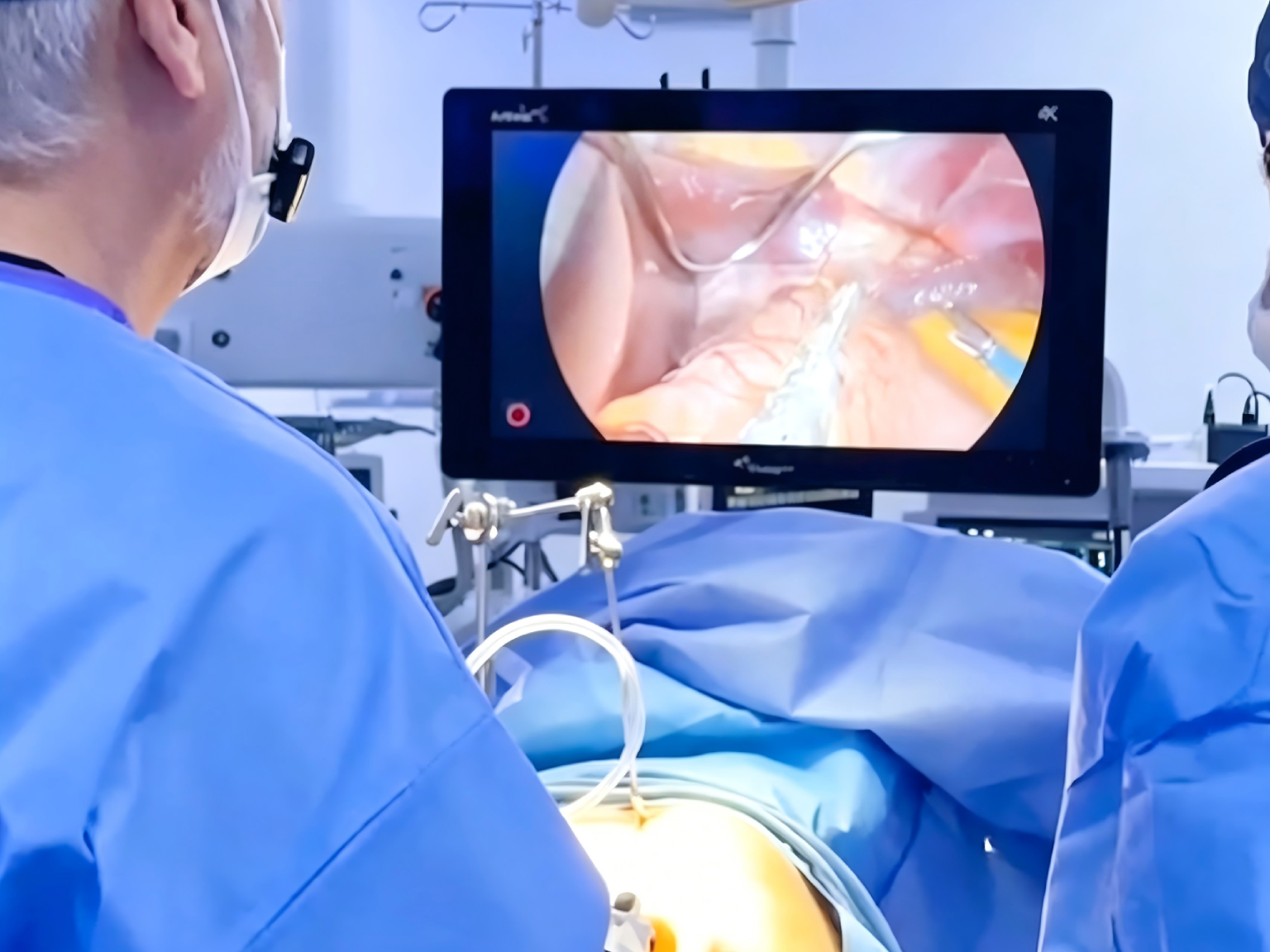 Powered Endoscopic Staplers-02
